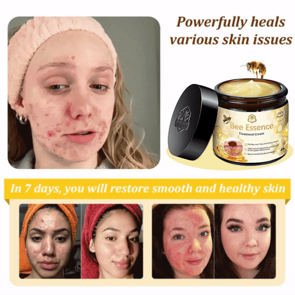 BENDCHARGE™ Bee Essence Skin Treatment Cream (AAD Recommended👨‍⚕️)