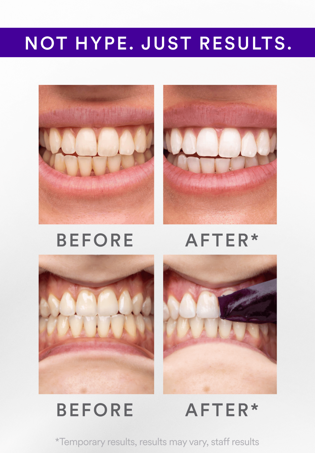 ⏰LAST DAY SALE 50% OFF💥Whitening Strips
