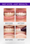 ⏰LAST DAY SALE 50% OFF💥Whitening Strips
