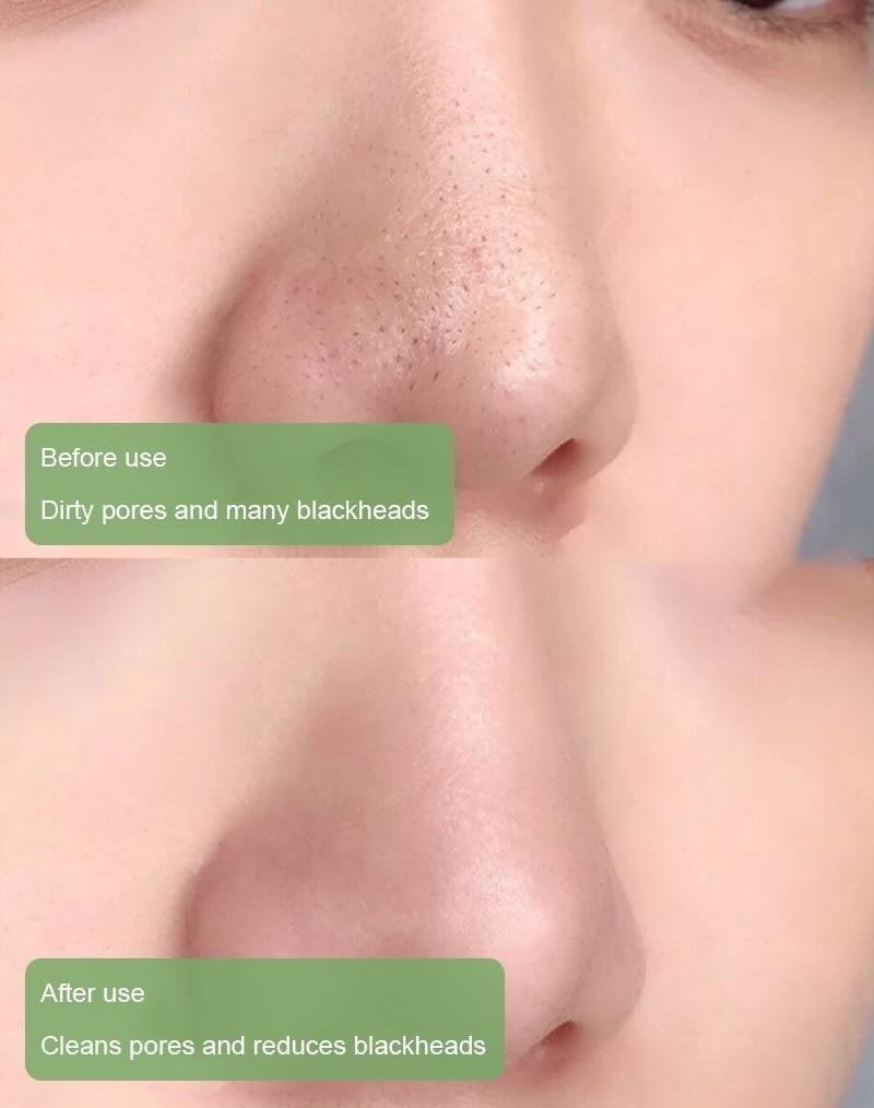 ✨Free shipping-Last Day 75% OFF 🔥-🍵 Deep Cleanse Green Tea Mask
