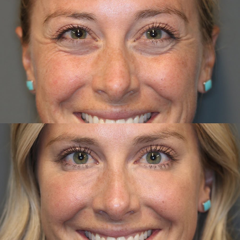 🔥Last Day 49% OFF - Pachyent® Retinol Eye Cream Stick🔥🔥BUY 2 GET 1 FREE