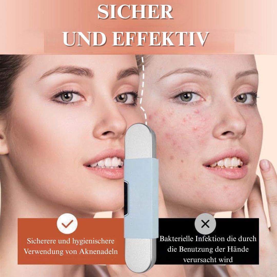 🏆Letzter Tag 49% Rabatt🔥Mitesserentferner-Werkzeugset aus Edelstahl