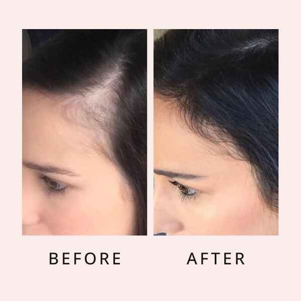 🔥Last Day Promotion 50% OFF🔥Hair Growth Serum