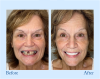 ✨Free shipping-BENDCHARGE™ - Premium Denture