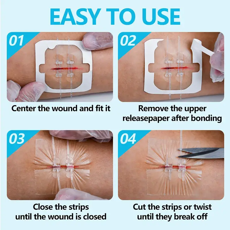 Stitchless Wound Closure Strips