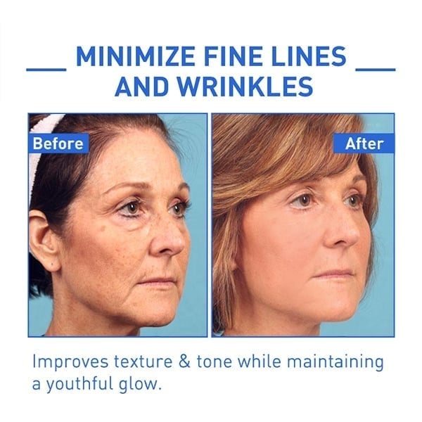 ⏰Last Day Discount 70% Off -💥 Botox Face Serum
