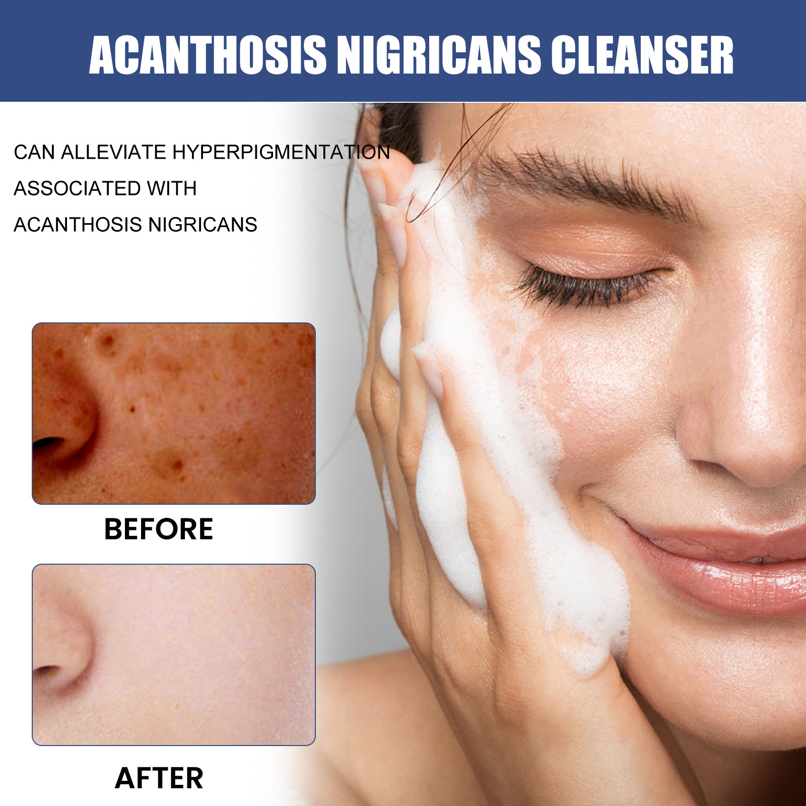 🔥LAST DAY 50% OFF🔥Brown-atto™ Cleansing Lotion for Acne & Spots & Acanthosis Nigricans