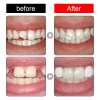 OTEH™ – The Ultimate Temporary Tooth Repair Solution for a Perfect Smile