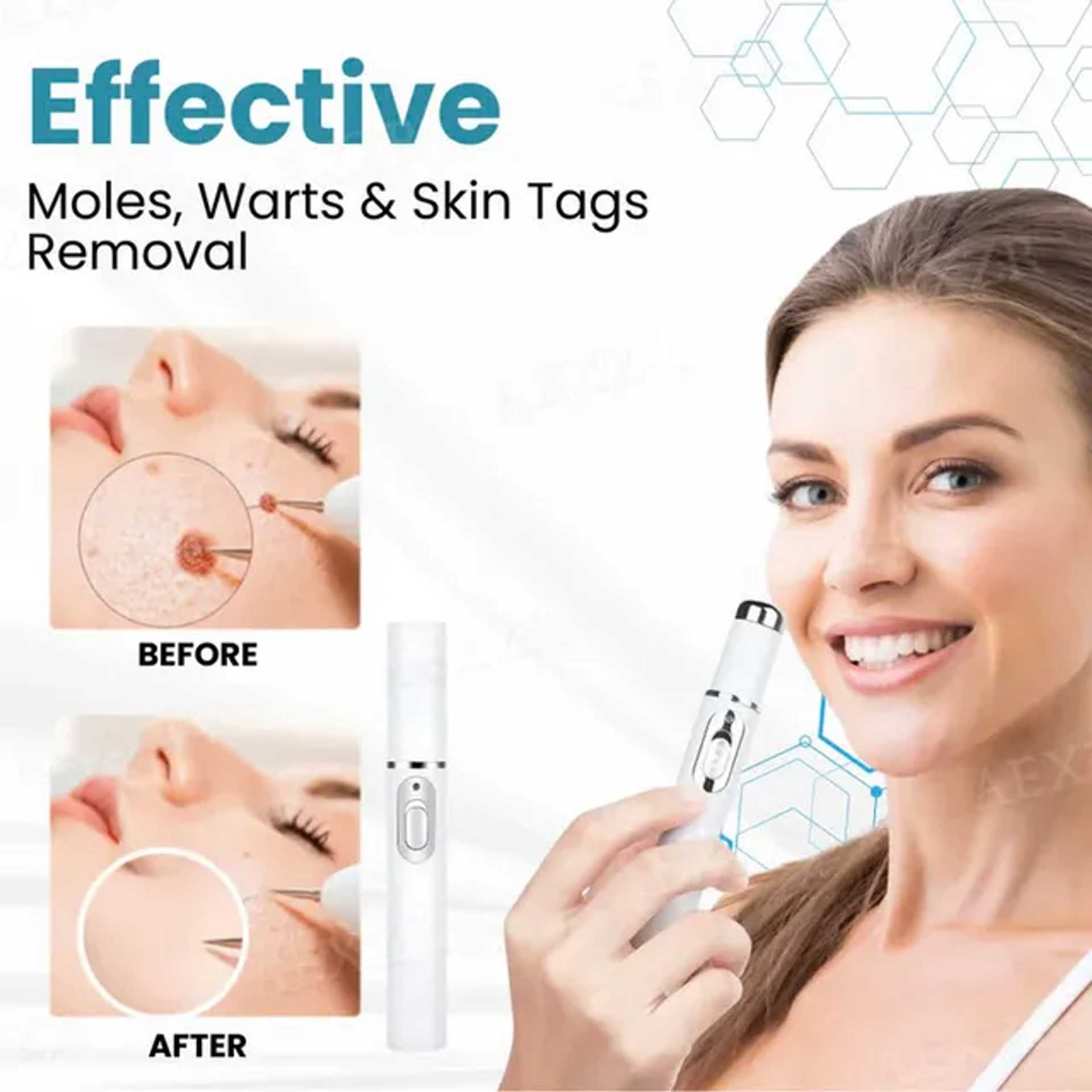 🔥Last Day Promotion 50% OFF💥Non-Invasive Mole and Wart Removal Laser Pen⚡️BUY 2 FREE SHIPPING