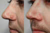 ⏰LAST DAY SALE 50% OFF💥Natural Skin Tag and Wart Removal Patches