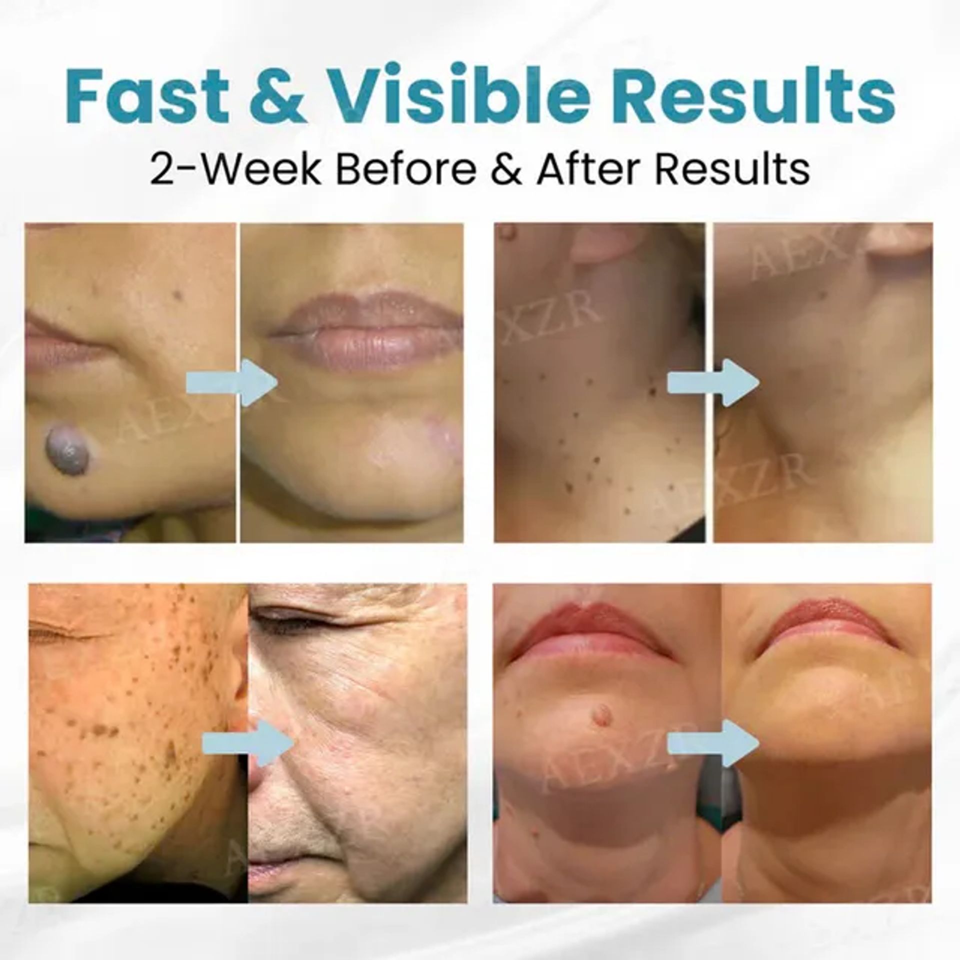🔥Last Day Promotion 50% OFF💥Non-Invasive Mole and Wart Removal Laser Pen⚡️BUY 2 FREE SHIPPING