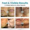 🔥Last Day Promotion 50% OFF💥Non-Invasive Mole and Wart Removal Laser Pen⚡️BUY 2 FREE SHIPPING
