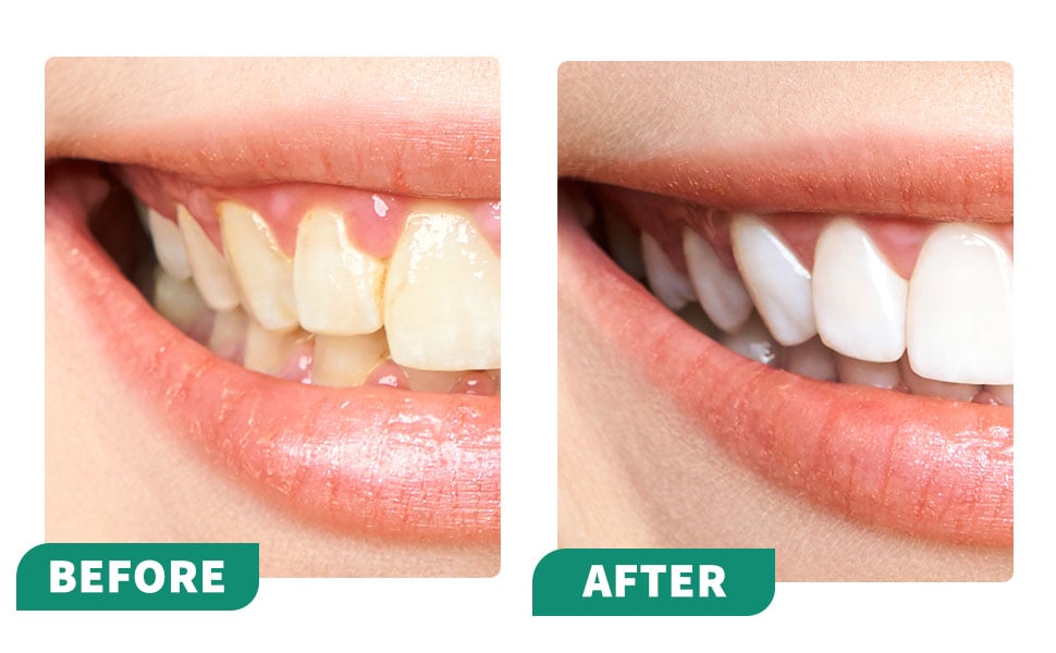 ⏰LAST DAY SALE 50% OFF💥Tooth whitening powder