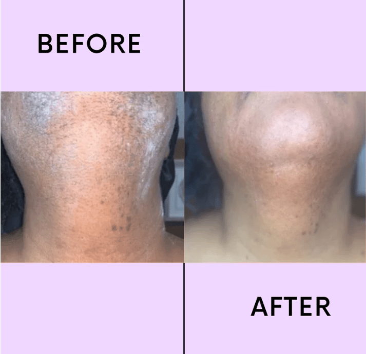 💖LAST DAY 50% OFF-🔥Hair Removal Kit-Buy 1 Get 1 Free