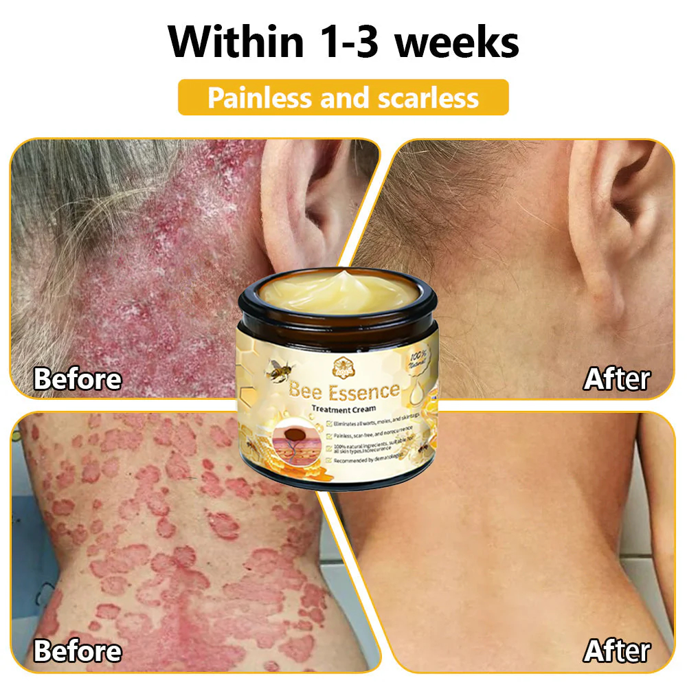 BENDCHARGE™ Bee Essence Skin Treatment Cream (AAD Recommended👨‍⚕️)