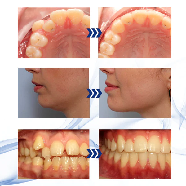 🔥Last Day Promotion 70% OFF-🔥-Jaw Alignment Brace