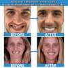 Clinclii™ Moldable False Teeth Restore Your Smile, Anytime. Anywhere