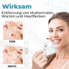 🎁-✨BENDCHARGE™ Nicht-invasiver Laser-Stift zur Entfernung von Muttermalen und Warzen✨