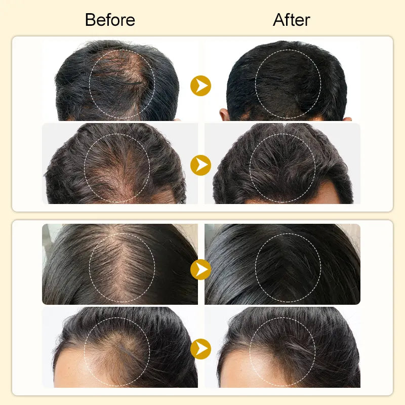 🔥LAST DAY 50% OFF 🔥PURC Hair Regrowth Treatment - Anti Hair Loss & Hair Growth