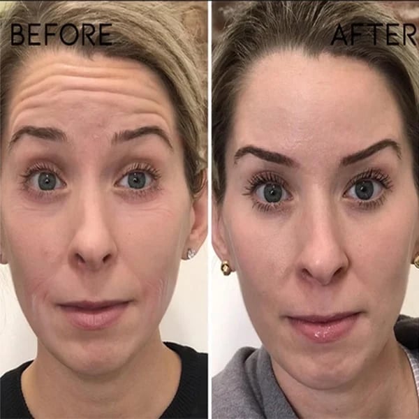 Last Day Promotion 49% OFF - 🔥2023 New Botox Face Serum