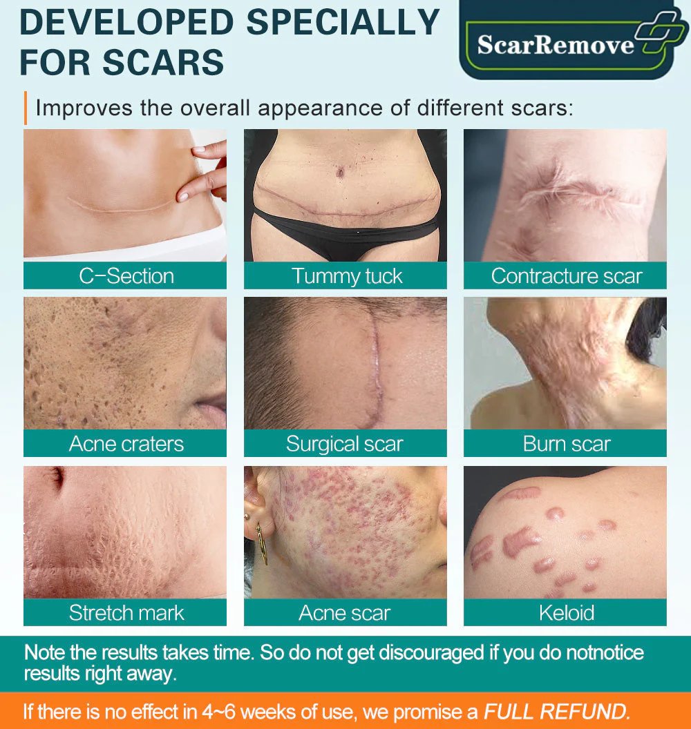 🔥LAST DAY 50% OFF❤️ScarRemove™ Advanced Scar Spray For All Types of Scars - For example Acne Scars, Surgical Scars and Stretch Marks -	BUY 3 FREE 1