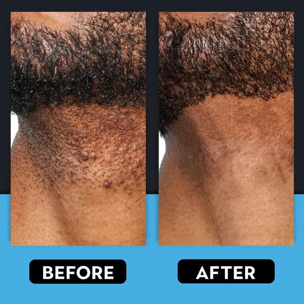 🎁LAST DAY 45% OFF🎁Razor Bump & Ingrown Hair Treatment