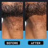 🎁LAST DAY 45% OFF🎁Razor Bump & Ingrown Hair Treatment