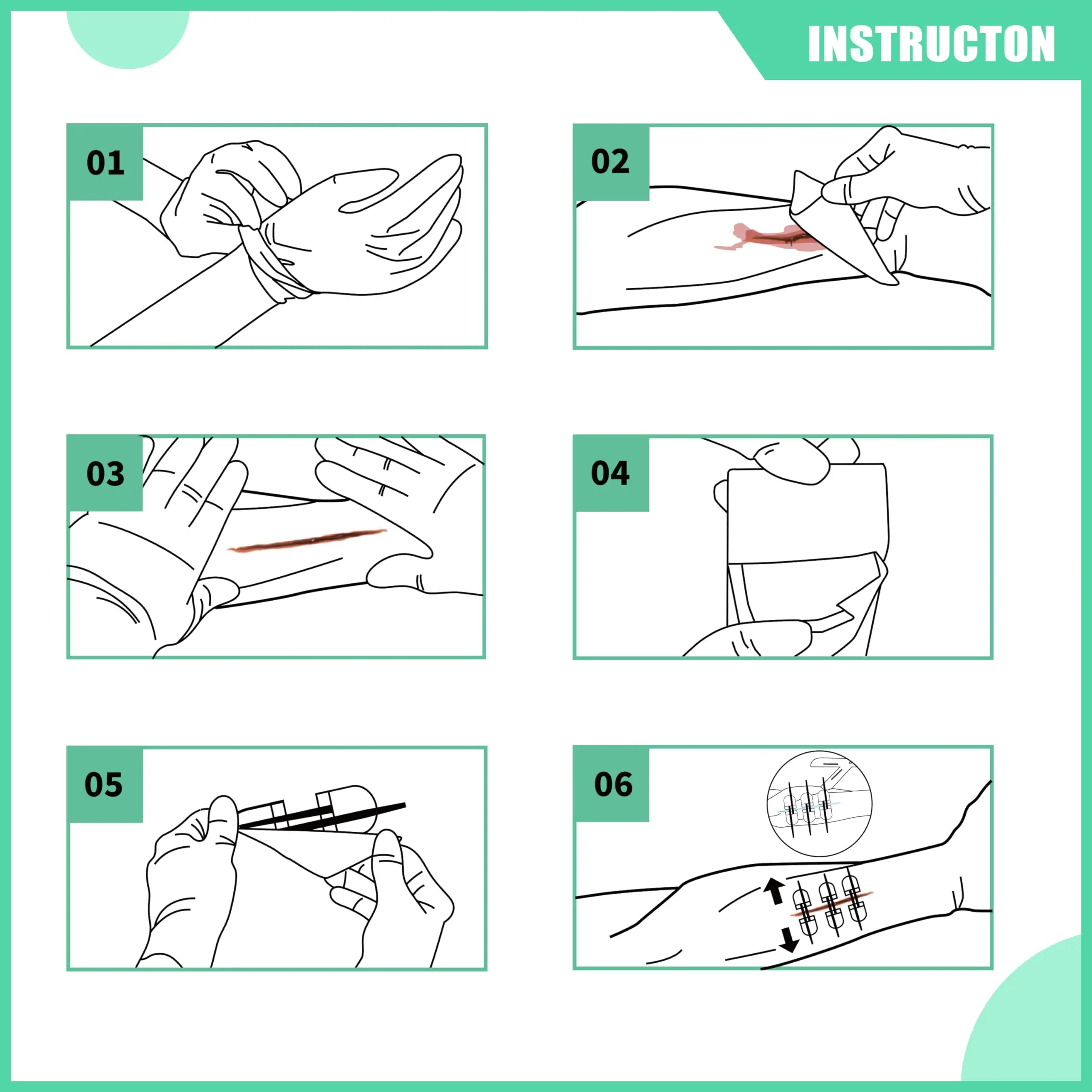 Stitchless Wound Closure Strips