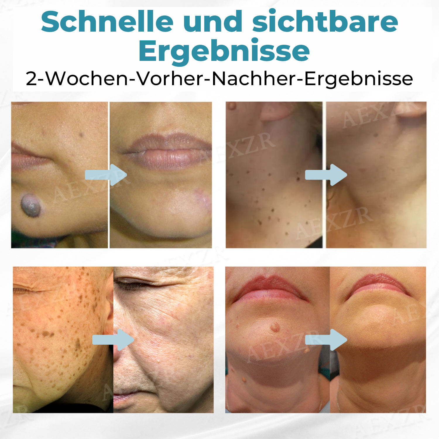 🎁-✨BENDCHARGE™ Nicht-invasiver Laser-Stift zur Entfernung von Muttermalen und Warzen✨