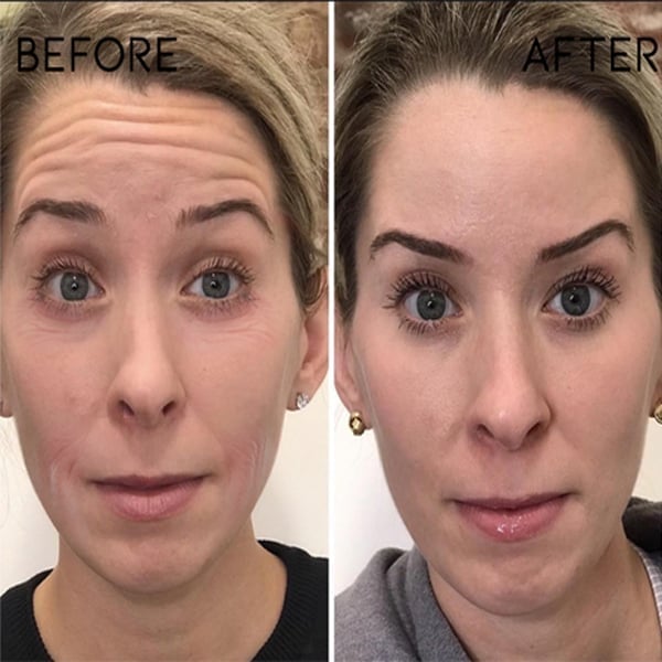⏰Last Day Discount 70% Off -💥 Botox Face Serum