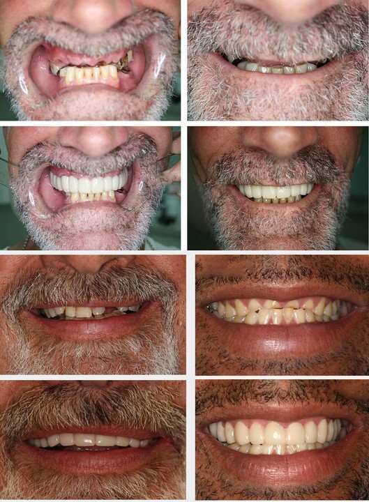 🔥Last Day Promotion 50% OFF-👨‍⚕Adjustable dentures😁