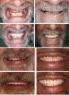 🔥Last Day Promotion 50% OFF-👨‍⚕Adjustable dentures😁