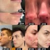 🔥Instrument zur Reinigung der Gesichtsporen
