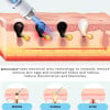 BENDCHARGE™ Non-Invasive Mole and Wart Removal Laser Pen